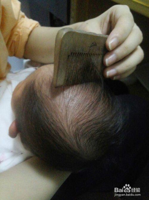 如何去除新生儿头垢