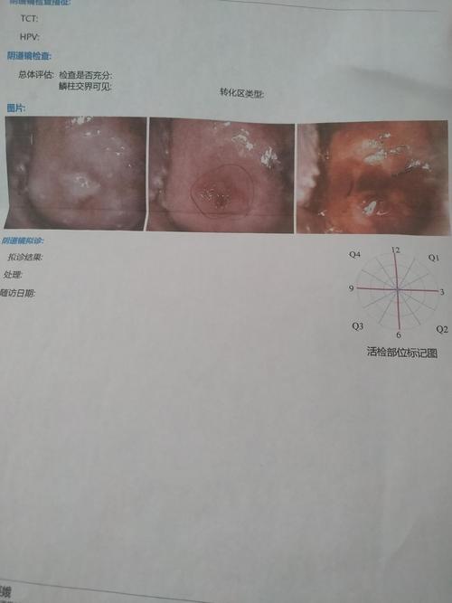 有帮看看的吗?宫颈口上面的白色东西是啥?