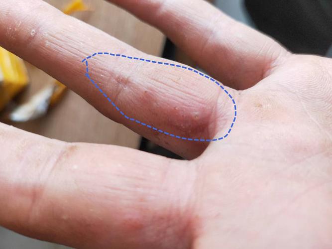 汗疱疹的"罪魁祸首"找到了!提醒:多半是体内湿热"预警