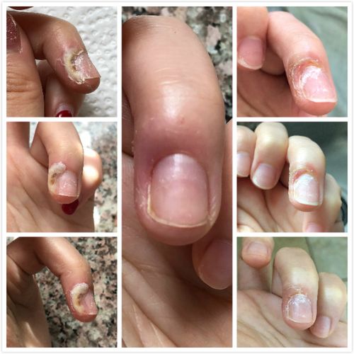 超详细的甲周疣治愈过程