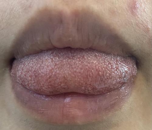 请问这个是口腔感染hpv的状态吗