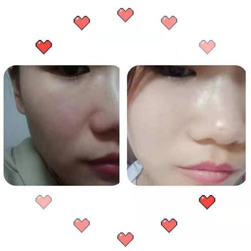 干皮救星轻医美项目水光针