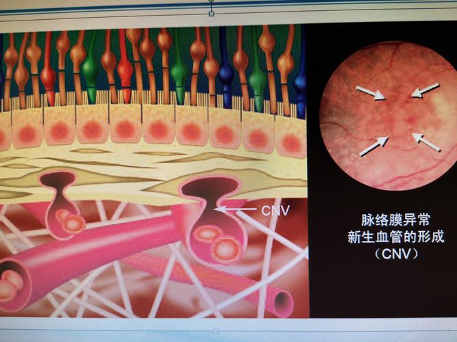 老年性黄斑变性的分型和防治