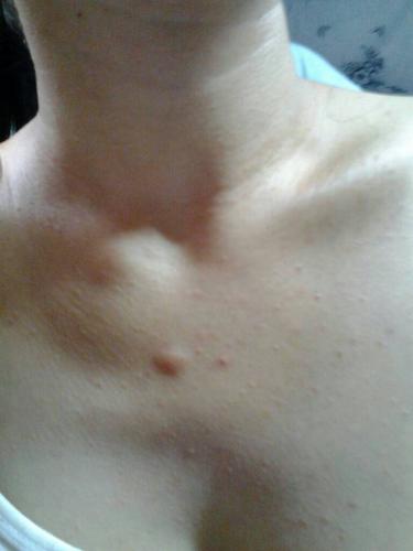 问:胸前长这痘什么原因呢 吃啥药呢