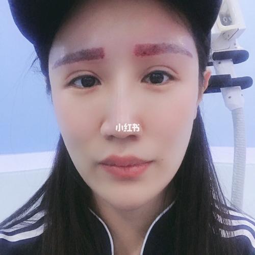 超皮秒洗眉经历分享～_眉毛_消肿_疤痕_egf_冰袋_整形_假发_美妆_医美