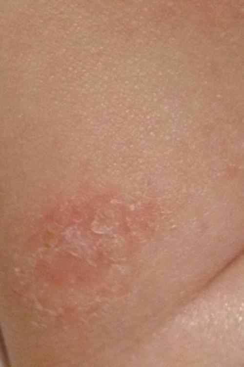 宝宝干性湿疹图片 (50)