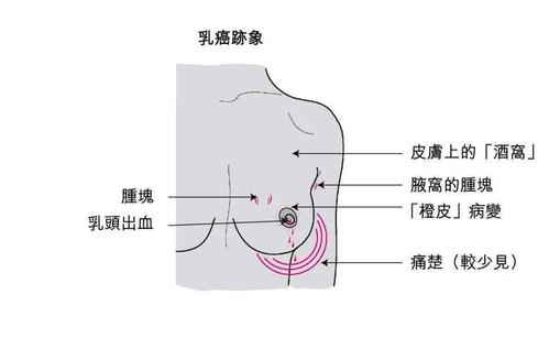 乳腺癌的早期症状