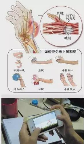 针灸治疗 ——狭窄性腱鞘炎