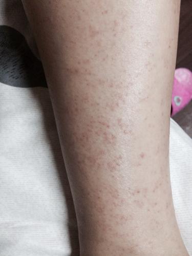 这个是紫癜吗?突然这样了.皮肤病还是血液病.