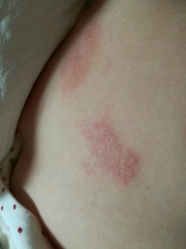 这是干性湿疹吗?怎么治