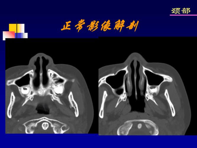 鼻旁窦常见疾病ct表现