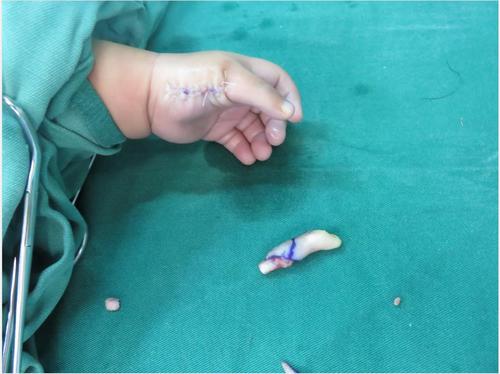 小孩多指切除案例_多指畸形_治疗方法_手术 - 好大夫