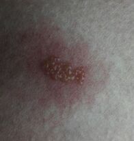 大腿上长了一块疱疹,有谁知道这是什么来着?怎么办呢?谢谢!