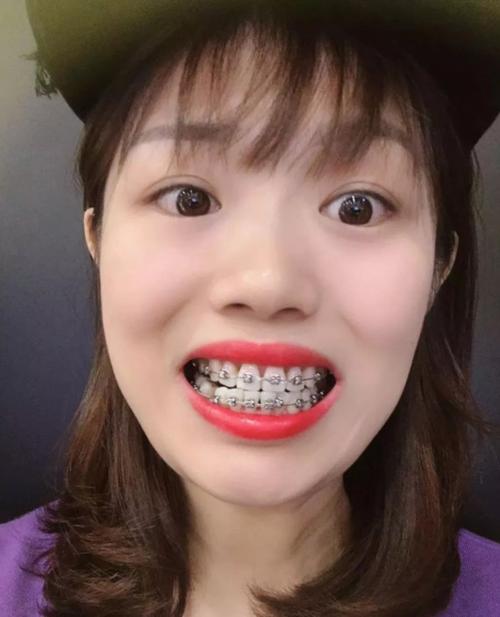 带牙套整整200天了