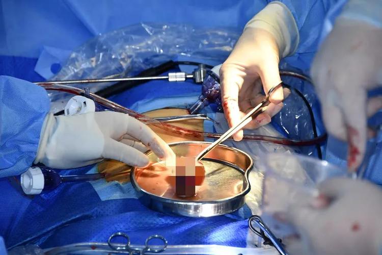 【杭州城东医院外科案例】胆囊结石微创切除 保住胆汁