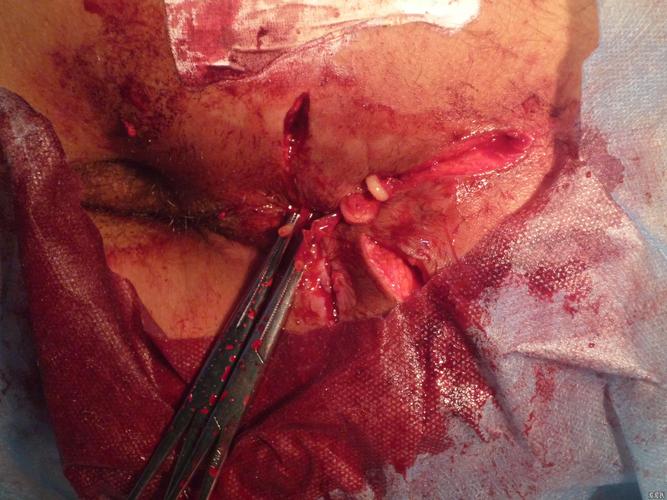 一例颇费周折的复杂肛瘘