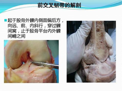 前交叉韧带的解剖   起于股骨外髁内侧面偏后方, 向远,前,内斜行