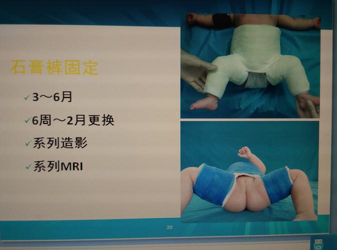 先天性髋关节脱位怎样早发现