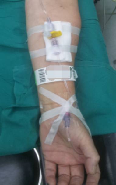 超声引导桡动脉穿刺,你需要掌握这些技巧!