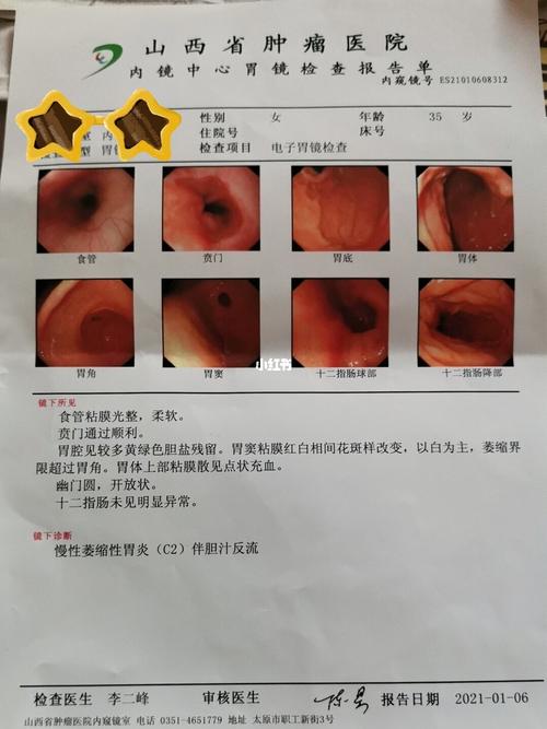 中度萎缩性胃炎伴胆汁反流