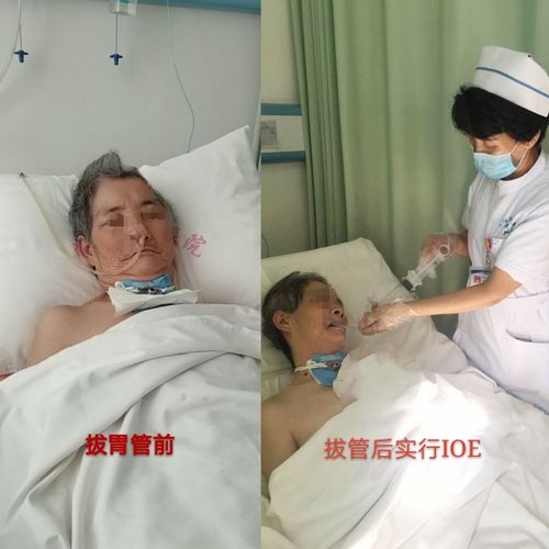 病人张某,女,62岁,住院第一天拔出胃管,行ioe;第二天拔出气管插管