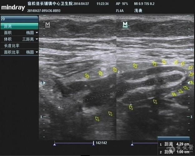 阑尾炎超声图片