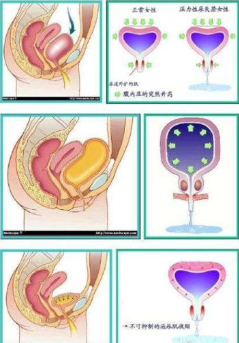 女性尿失禁