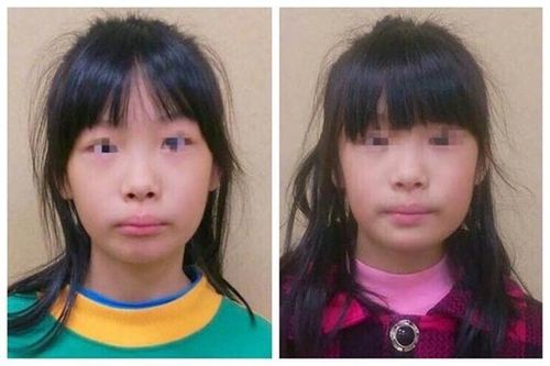 腺样体肥大的临床表现