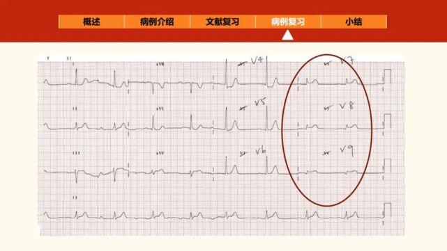 "正后壁"心肌梗死的心电图线索