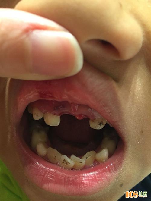 这是牙菌斑吗?要怎么样才能清洁