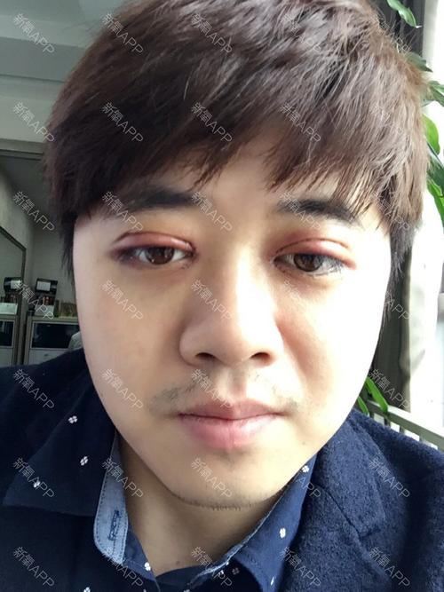 今天一早出门在车上突然间眼睛剧痛,想把眼睛挖掉的痛感;医生说是在