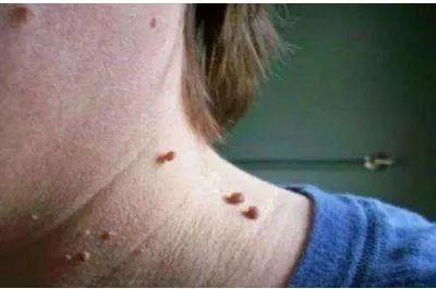 原创脖子上若出现这3个异常,可能是癌细胞"苏醒"的前兆,别大意了