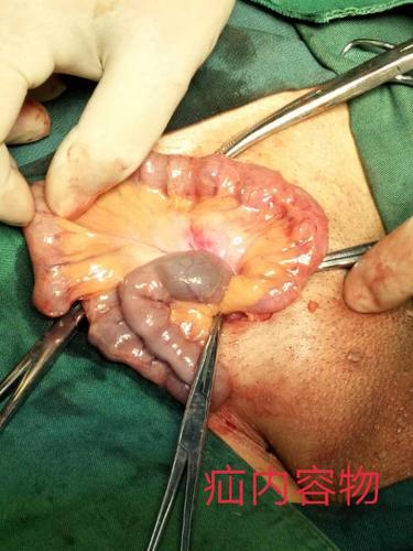 中医院外科成功为巨大疝患者施行无张力修补术