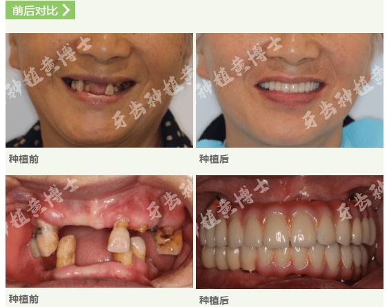 种植牙真的那么可怕吗?听杭州种植牙专家黄博士为您解答