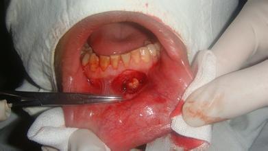 牙龈囊肿的介绍