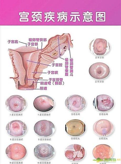 轻度宫颈糜烂图 (8)