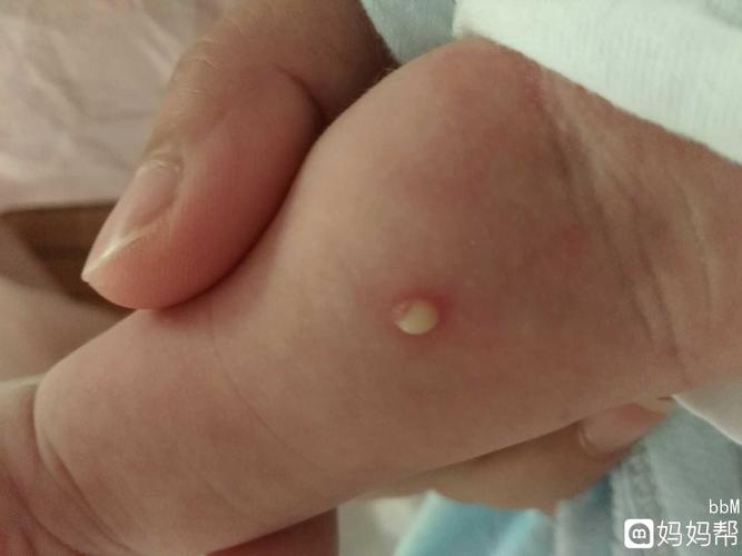 宝宝手臂上长了个脓包