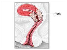 传统的手术方法是经腹或经阴道将子宫切除.