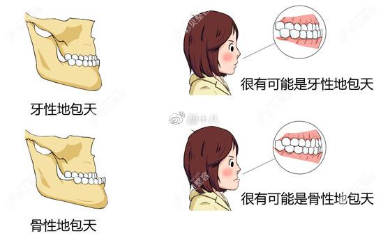 梳理成年人骨性地包天能做掩饰性正畸吗做完对脸型有影响吗