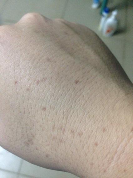 手背出现点点斑纹是为什么