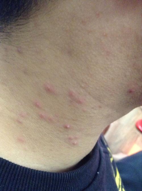 最近脖子上长了好多痘痘,怎么办