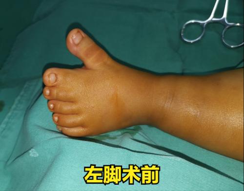 双手并指,双足多趾伴并趾治疗实例