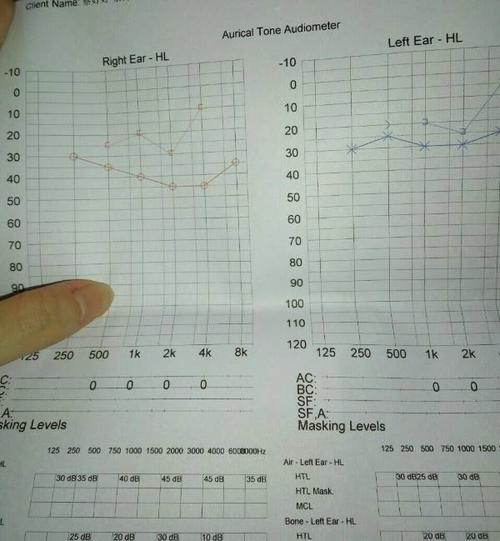 纯音听阈测试怎么看?右耳得过中耳炎.