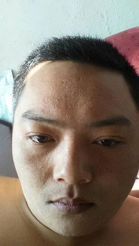 脸上起皮,皮特别多,还痒,是怎么了?急求专业人士解答