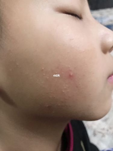 七岁孩子两个腮上长白色粉刺似的痘痘_痘痘_粉刺_母婴