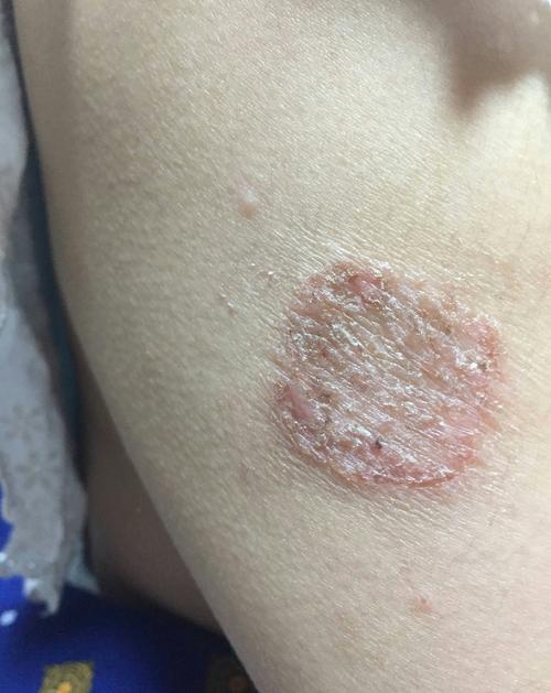 体癣湿疹化