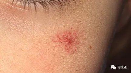 年近40身体长出"小樱桃"?老年性血管瘤是衰老表征