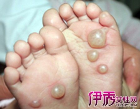 【图】病毒性疱疹会传染吗 有哪些治疗方法呢