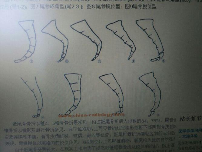 尾椎骨,骨折与否