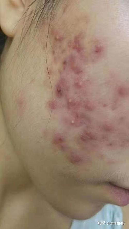 这是典型的丘疹型痘痘,炎症跟脓包很严重,平时我们首先要注意休息